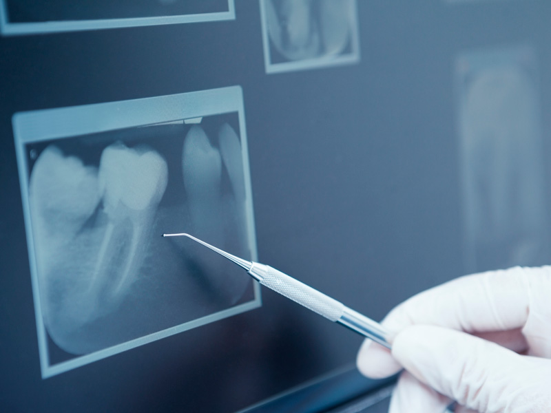 Che cos’è l’endodonzia?